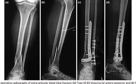 Figure 2 From Minimally Invasive Osteosynthesis Of Distal Tibia