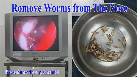 Worms In Human Nose Video Shows Doctors Removing 67 Worms From Nose Youtube