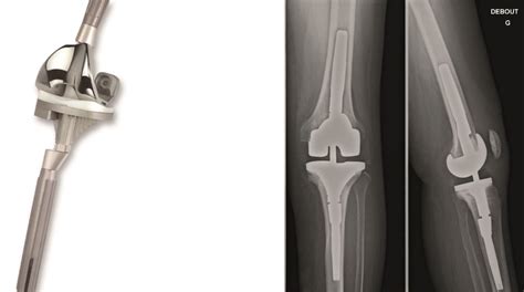 Une prothèse du genou est un implant articulaire interne qui remplace les surfaces articulaires défaillantes du genou, dans le but de permettre de nouveau un appui stable, la flexion et l'extension, et de récupérer un bon périmètre de marche. La prothèse de genou | Eich