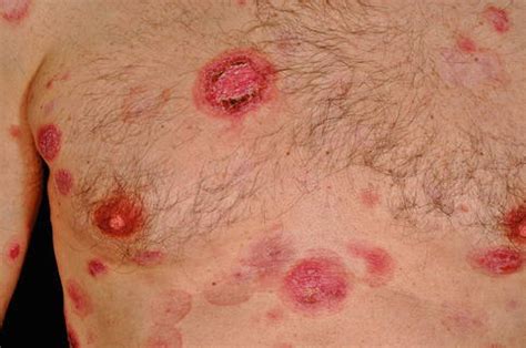 Treatments considered will depend on the individual patient, specific type of. Cutaneous T-Cell Lymphoma | Oncohema Key