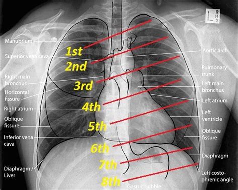 We did not find results for: MBBS DOCTORS: Basics of Reading Chest X ray | Nurse, Radiology, Chest xray