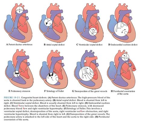Advanced Pathophysiology Congenital Heart Defects Heart Defect
