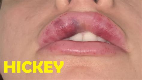 How To Give Someone A Hickey On The Lips Tutorial Youtube