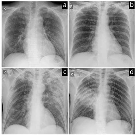 Diagnostics Free Full Text Artificial Intelligence Applied To Chest