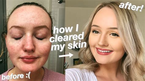 How I Finally Cleared My Skin Got Rid Of My Acne Youtube