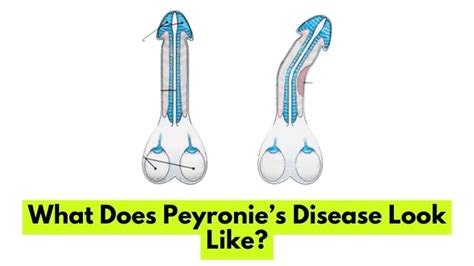 What Does Peyronies Disease Look Like
