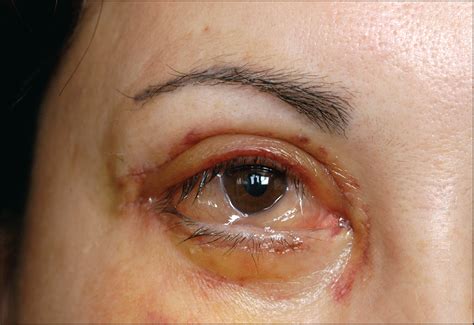 Dry Eye Symptoms And Chemosis Following Blepharoplasty A 10 Year