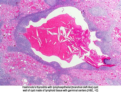 Pathology Outlines Branchial Pouch Cleft Anomalies