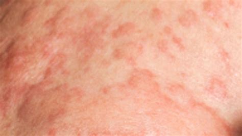 Chloromas develop most often in the bone, skin, lymph nodes, breast, ovary, meninges (membranes that cover and protect the. Bone Marrow Transplants and Graft vs. Host Disease