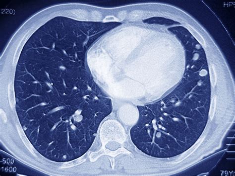Medicare Poised To Cover Ct Scans To Screen For Lung Cancer Shots
