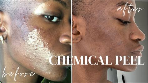 Jessner Chemical Peel Before And After Youtube