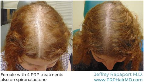 Learn how exosomes are a more advanced alternative to prp for treating exosomes from follicular stem cells, the logic goes, facilitate hair growth and can help prevent hair loss.</p. PRP Hair Loss Before And After Gallery| PRP Hair Results ...