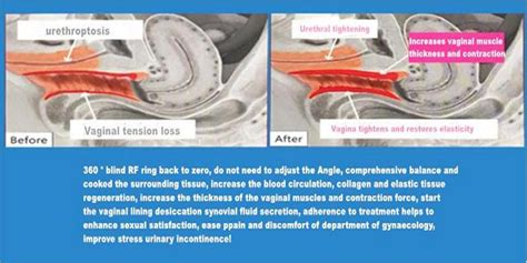 Non Invasive Vaginal Rejuvenation Rf Vaginal Tightening Machine Female Private Vagina Care