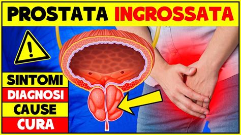 Prostata Ingrossata Sintomi Diagnosi Cause E Cura Iperplasia