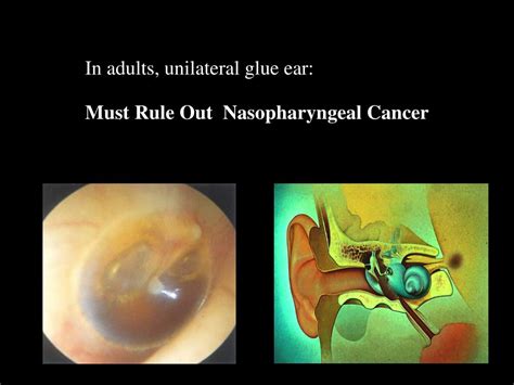 Ppt Diseases Of Middle Ear Powerpoint Presentation Free Download