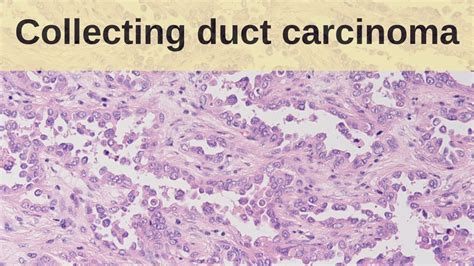 Collecting Duct Carcinoma Pathology Mini Tutorial Youtube