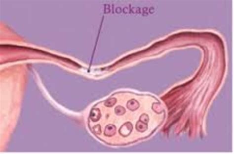 Fallopian Tube Block In Infertility What Can You Do By Dr Sujoy