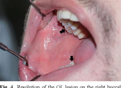 Oral Leukoplakia Associated With Amalgam Restorations Semantic Scholar