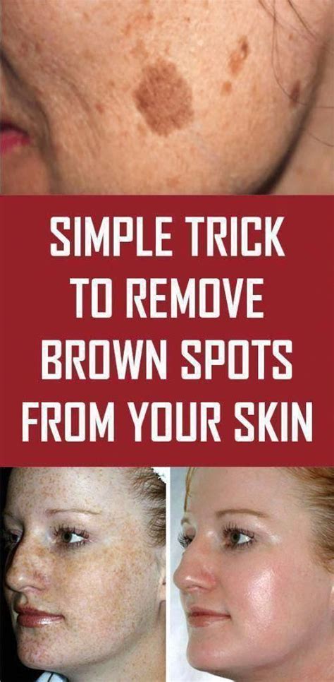 Pin En Brown Spots On Face