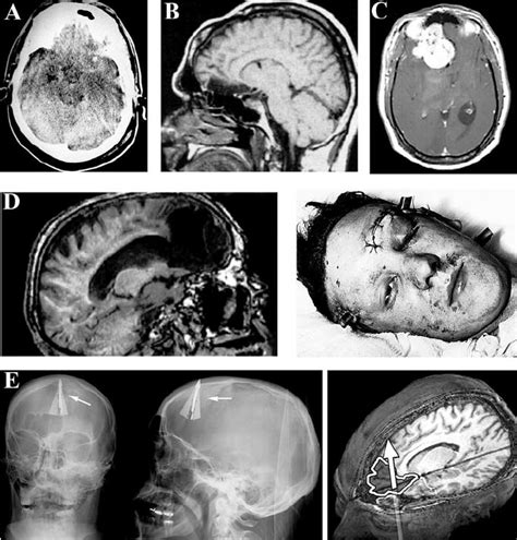 Cases Where Brain Anomalies Have Or Have Not Been Linked To