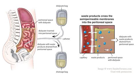 Peritoneal Dialysis Tyneside KPA