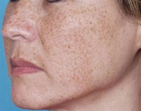 Everything Youve Ever Wanted To Know About Brown Spots And More