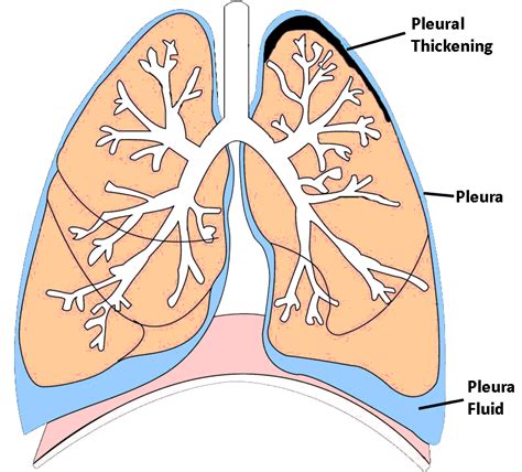 Pleural Thickening Lungs Mesothelioma Treatment Centers