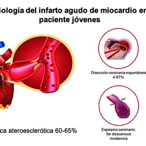 Esquema De Las Principales Causas Del Infarto Agudo De Miocardio En