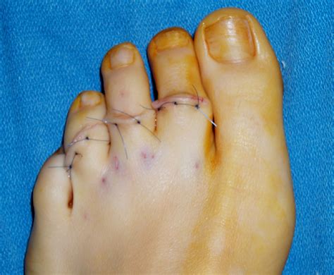 Toe Deformities The Tagoe Clinic
