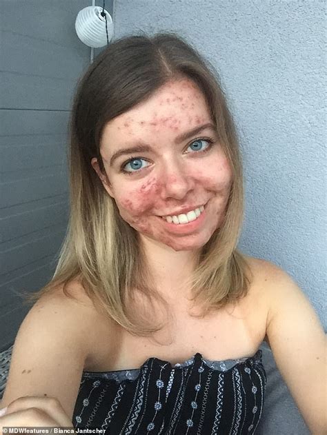 Woman Suffered From A Catastrophic Acne Breakout Aged 25 After Getting Off The Pill Daily