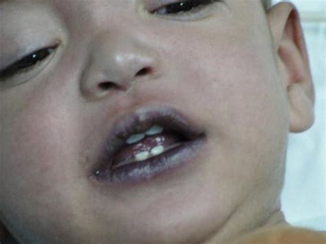 Pediatrics Notes A Child Presenting With Cyanosis Differential Diagnosis