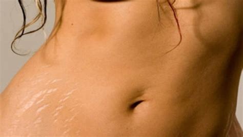 5 Natural Remedies To Remove Scars And Stretch Marks Healthy Food Advice