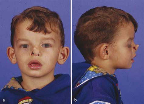 6 Rare Craniofacial Clefts Plastic Surgery Key