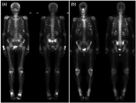 Radioisotope Whole Body Bone Scan A Increased Focal Uptake