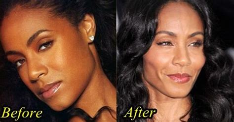 Jada Pinkett Smith Plastic Surgery With Before And After