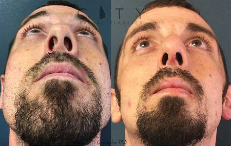 Deviated Nasal Septum Before And After