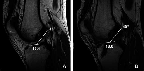 Was playing football last sunday and while making a cut felt something in his right knee. Bilateral MRI scans of a patient after right knee anterior cruciate... | Download Scientific Diagram