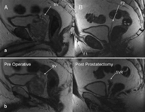 Sagittal T2-weighted images in a 51-year-old man showing ...