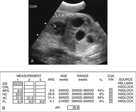 Gestational Age Ultrasound Dating Telegraph