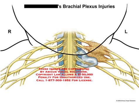 Brachial Plexus Injuries