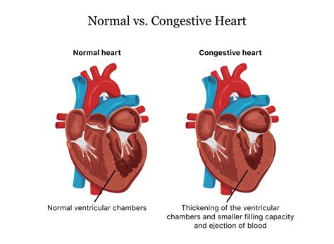 Cardiovascular Model Four Parts Of Human Heart Enlargement Model
