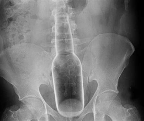 Bizarre Objects Stuck Inside Peoples Orifices That Required Emergency Room Visits Are Revealed