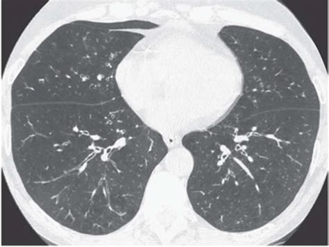 Small Airway Diseases | Radiology Key