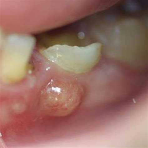 Tooth Abscess 5 Stages Symptoms Pictures And Treatment 2022