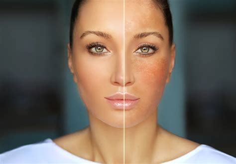 Uneven Skin Tone Understanding Its Causes And Treatment