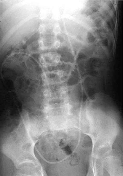 Plain Anteroposterior Radiography Of The Abdomen Showing The