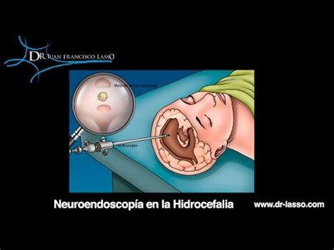 cirugia mínimamente invasiva para hidrocefalia YouTube
