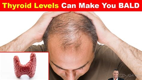 Thyroid hormones regulate our cell metabolism, so if something goes wrong, then it can have major having an underactive thyroid is more common than having an overactive one. 👱 Thyroid levels CAN cause hair loss and balding - Hair ...