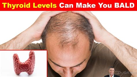 Includes common and rare side effects information for consumers and healthcare professionals. Thyroid And Hair Loss | Galhairs