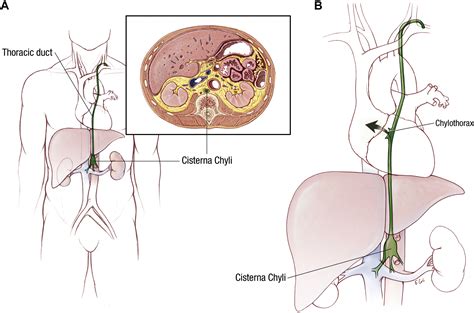 Treatment Of Postsurgical Chylothorax The Annals Of Thoracic Surgery